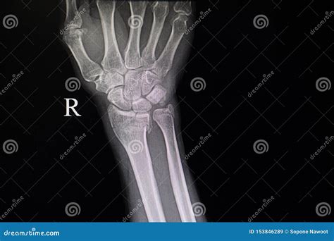 xray film  fracture wrist bones stock image image  operation