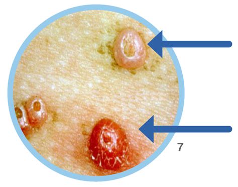Home - Molucide | Molucide: the solution | Molluscum contagiosum