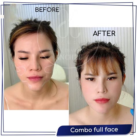 Tiêm Filler Má Baby Bao Nhiêu Tiền Giữ Bao Lâu Cần Bao Nhiêu Cc 2024