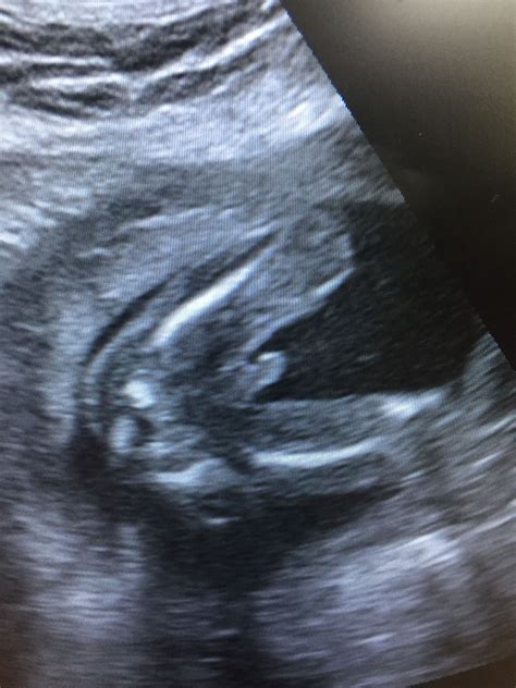 Determine The Sex Of A Baby Girl With Ultrasounds Artofit