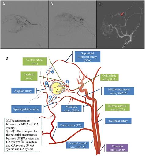 Frontiers Comparison Of Intra Arterial Chemotherapy Efficacy