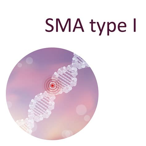 Spinal Muscular Atrophy Type 1 Rare Disease Advisor