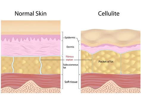 4 Top Reasons To Consider Cellulite Reduction Therapy