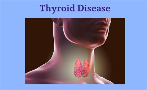 Thyroid Disease: Causes, Symptoms and Management | Dubai, UAE ...