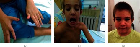 On Two Cases With Autosomal Dominant Hyper Ige Syndrome Importance Of