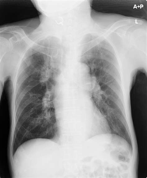 Asymptomatic Entrapped Denture In The Hypopharynx Bmj Case Reports