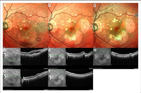 Figure From Sequential Retinal Pigment Epithelium Tears Following