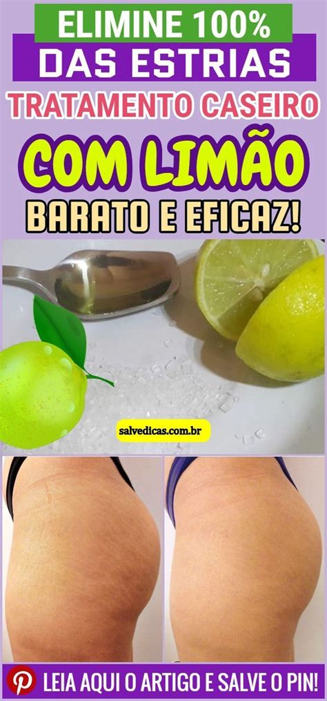 Receita Natural Para Remover Estrias Em Casa Passo A Passo Receita