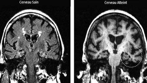 Un Test Pour D Tecter Alzheimer Ans Avant Les Premiers Sympt Mes