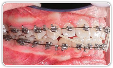 Speed System Orthodontics