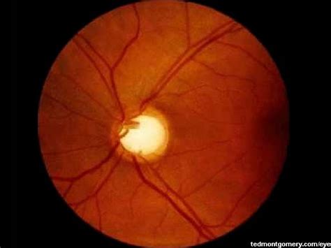 Glaucomatous Cupping: #1