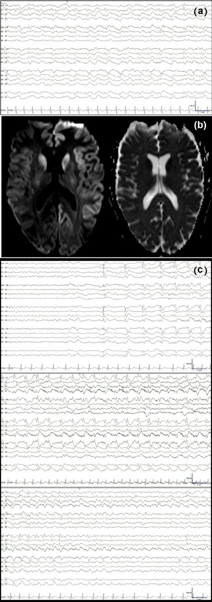 A Generalized Periodic Discharges Following Anoxic Brain Injury B Download Scientific