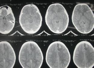 Homeopathic Treatment of Tuberculoma of the Brain