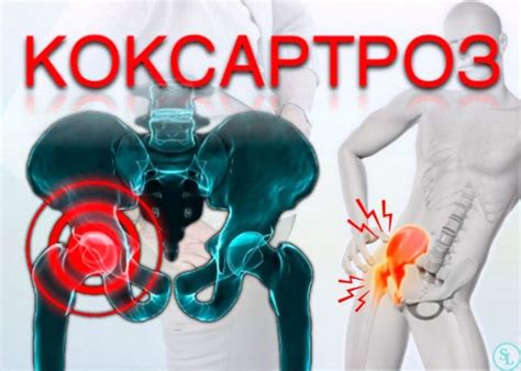 Коксартроз тазобедренного сустава. Причины, симптомы и лечение