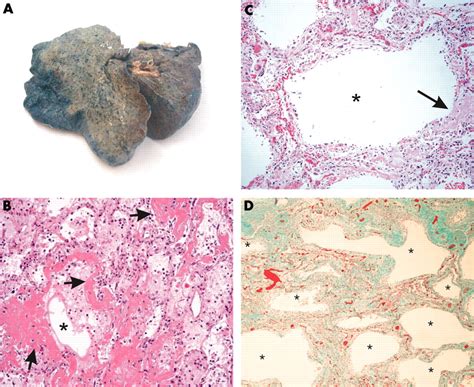 Pulmonary Pathological Features In Coronavirus Associated Severe Acute