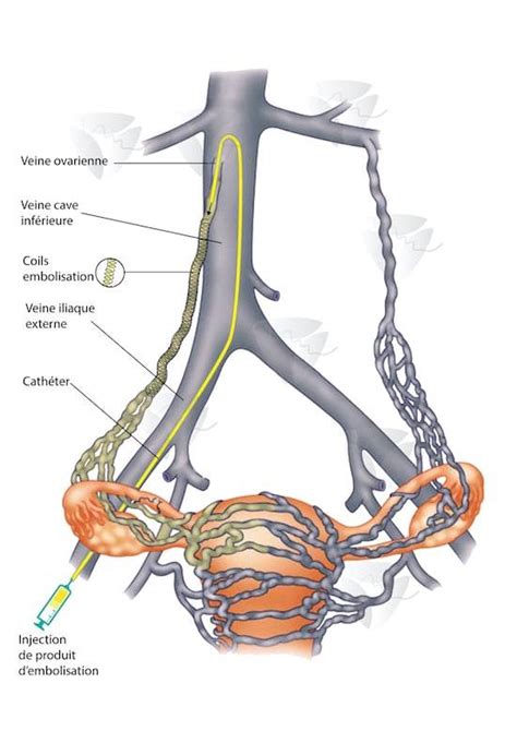 Traitement Varices Pelviennes Centre Varices Pelviennes