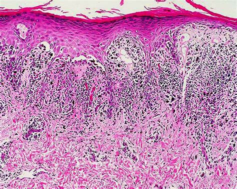 Lichen Planus Histology Sawtooth