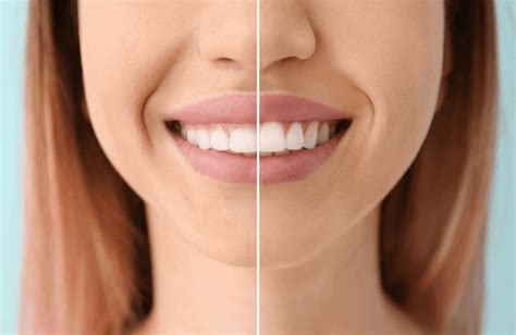 Sonrisa Gingival ¿cómo Corregirla Lora Boutique Dental