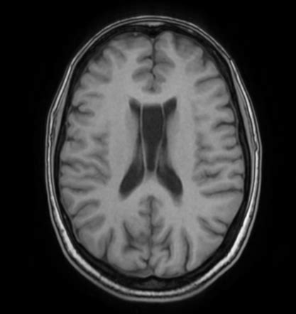 Cavum Septum Pellucidum Radiology Reference Article Radiopaedia Org