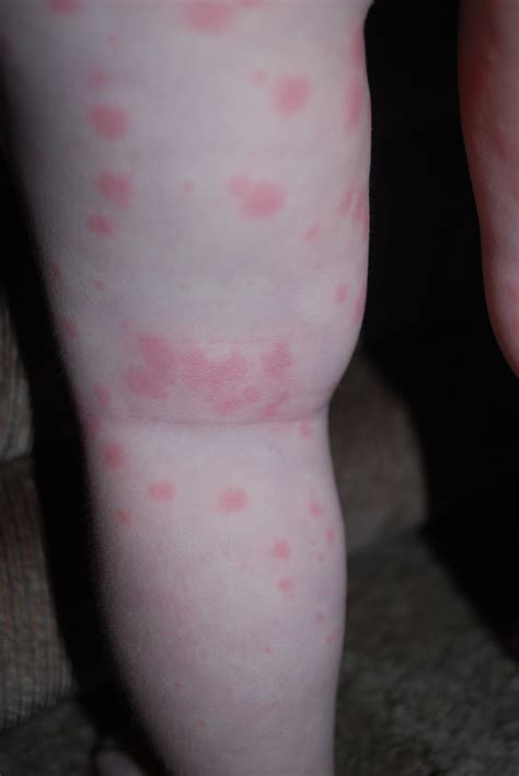 A Handful of Blessings: Mysterious Rash