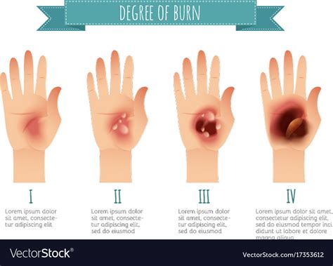 Degree Skin Burns Flat Royalty Free Vector Image