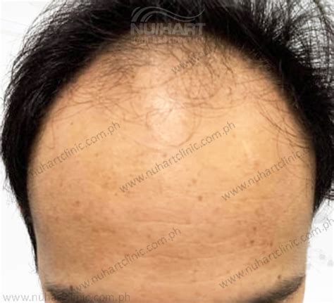 Fue Hair Transplant Philippines Nuhart Philippines