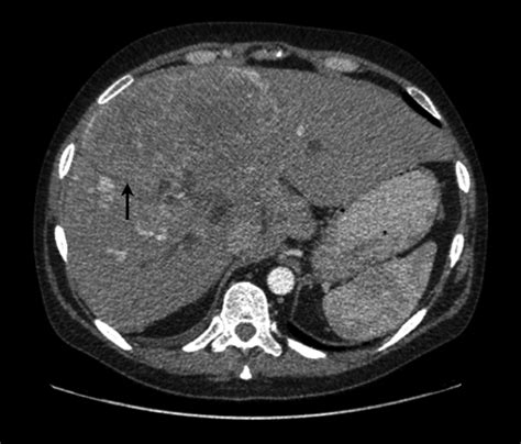 Neurological red flag: the numb chin | Practical Neurology