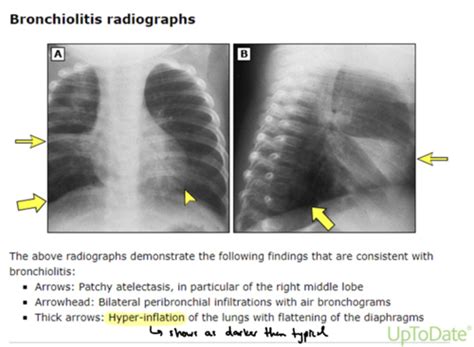 Pulmonology 583 Bronchial Diseases Flashcards Quizlet