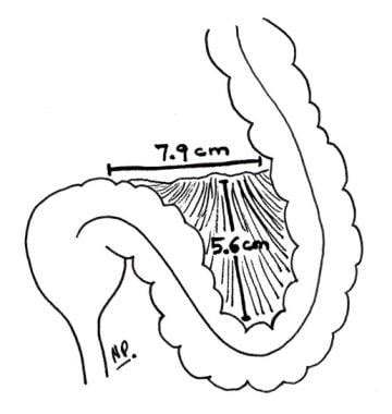 What is the anatomy of the mesosigmoid relevant to sigmoid and cecal ...