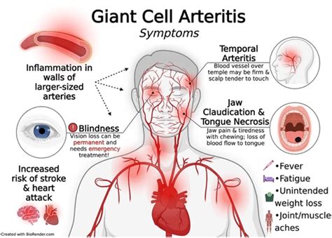 Giant Cell Arteritis Alberta Rheumatology