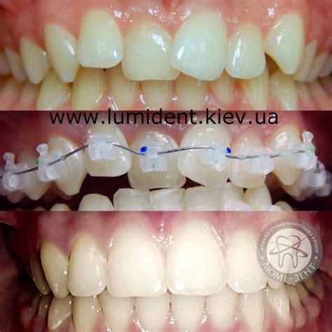 Брекеты Damon Clear, Даймон Клеар Киев цена- Люми Дент