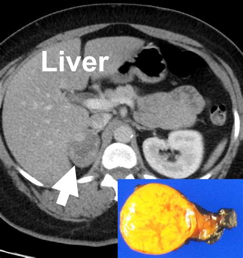 X-Rays, CT Scans, MRI, and Other Tests for Adrenal Glands