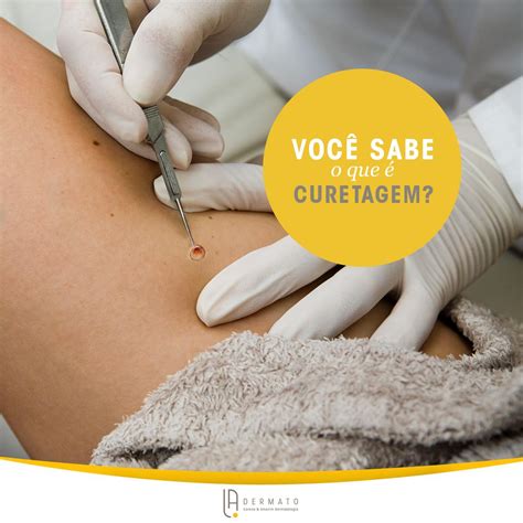 O Que Significa Curetagem - Clínica La Dermato - Curetagem é o termo que descreve a raspagem ...
