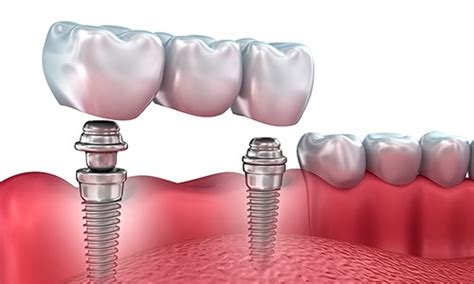 Puentes Dentales Son Mejores Que Los Implantes Ferrus Bratos