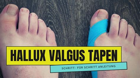 Hallux Valgus Tapen So Einfach Geht Es Youtube