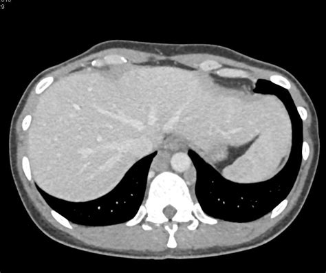 Pancreatic Adenocarcinoma With Extensive Adenopathy Liver Metastases