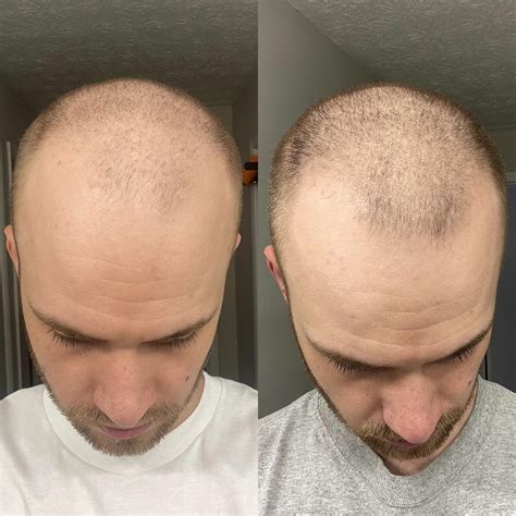 7 Weeks On Topical Finasteride And Minoxidil Looking Promising R Hairloss