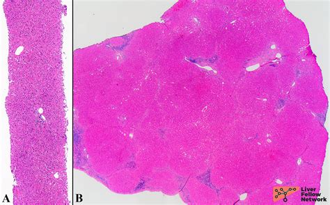 The Liver Biopsy Importance And Interpretation Aasld
