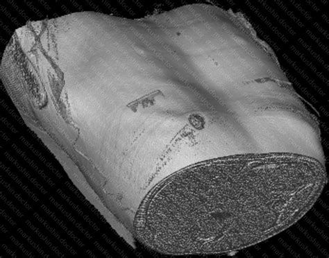 Как реально помогает вакуумный колокол Vacuum bell при воронкообразной ...
