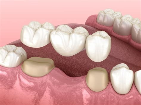 Dental Crown Vs Dental Bridge What You Need To Know Alamo Springs
