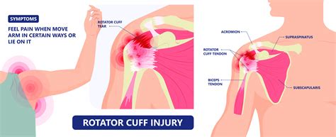 Rotator Cuff Injury | Florida Joint Care Institute | Trinity, FL