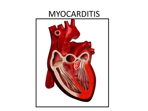 heart symptoms myocarditis