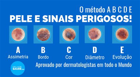 Sinal Preto Na Pele - SINAIS NA PELE PERIGOSOS COMO DETETAR