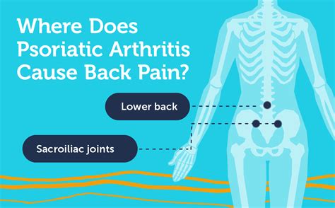 What Back Pain With Psoriatic Arthritis Feels Like | MyPsoriasisTeam