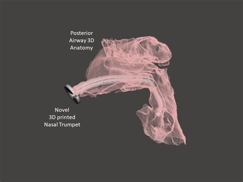 Improved Nasal Trumpet Design For Fiberoptic Intubation