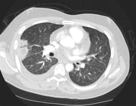 Signs In Radiology Feeding Vessel Sign Lungs