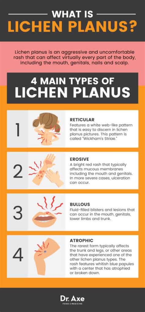 lichen planus  natural ways  treat  nasty rash dr axe