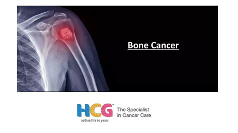 Ppt Bone Cancer Treatment Powerpoint Presentation Free Download Id 11643227