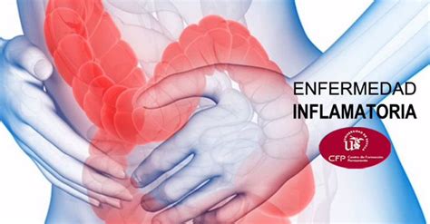 M Ster En Enfermedad Inflamatoria Intestinal Sapd Sociedad Andaluza