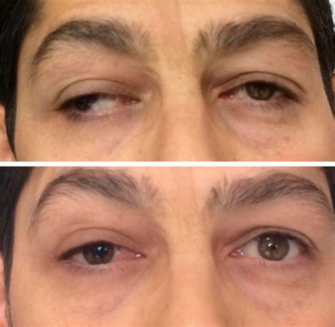 Strabismus Surgery Before And After Photos